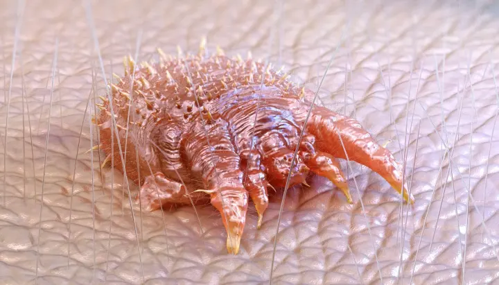 Visiting Restrictions Imposed At Morriston Hospital Following Scabies Outbreak