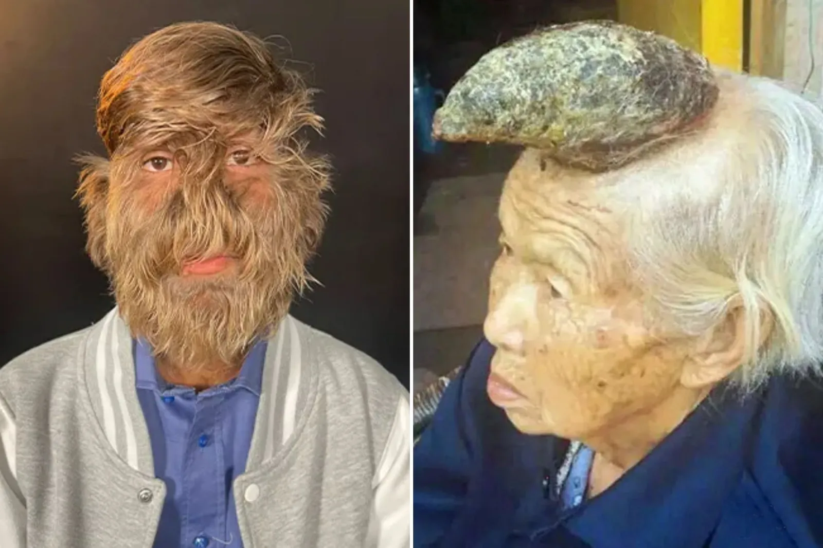 Real Life Medical Conditions That Mirror Classic Halloween Monsters